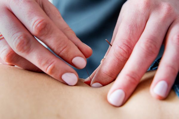 Acupuncture - Downtown Toronto Chiropractor, Dr. Lisa Clarke